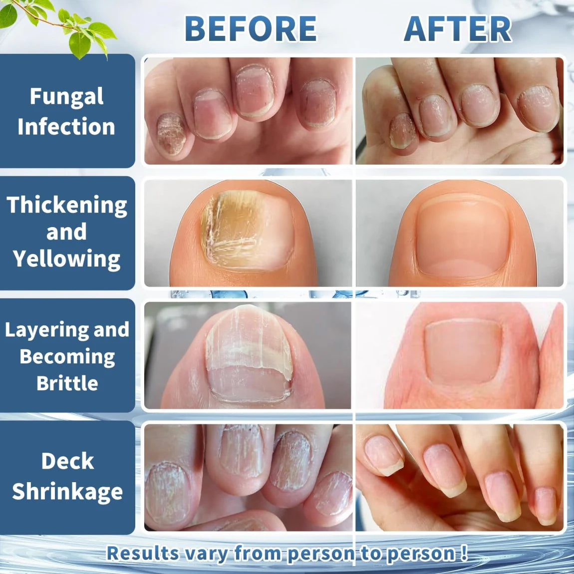 3-Day Maximum Intensity Nail Fungus Treatment - Fast-Acting Liquid Drops